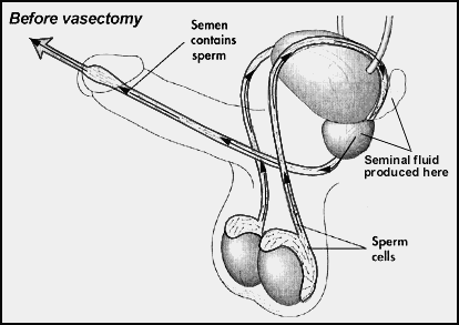 Vasectomy-Before
